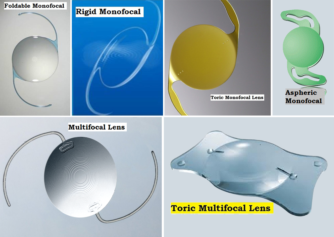 Types of Intraocular Lenses IOLs
